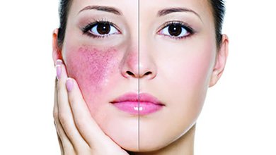 rosacea-small.jpg